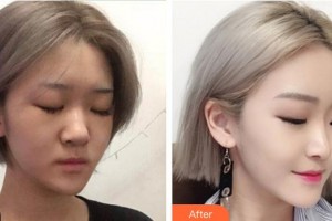 成都暄妍醫(yī)療美容門診部潘寧整形價格表附鼻部手術(shù)整形案例展示