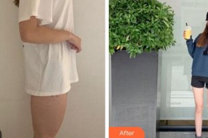 成都怡脂醫(yī)療美容醫(yī)院鄧萌整形價格表附大腿吸脂案例展示