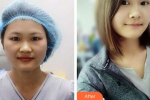 成都愛迪眼科醫(yī)院胡玉章整形價格表附眼部綜合案例展示