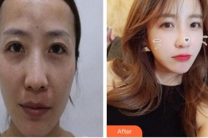 成都中醫(yī)藥大學附屬醫(yī)院銀海醫(yī)美何軍整形價格表附脂肪填充案例展示