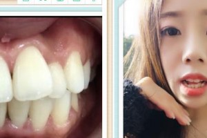 成都康橋眼科醫(yī)院雷仲其整形價格表附牙齒矯正案例展示