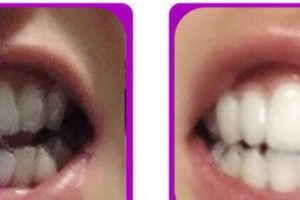 成都康橋眼科醫(yī)院巫雷整形價格表附牙齒矯正案例展示