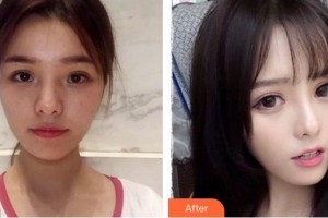 成都愛迪眼科醫(yī)院曾慶華整形價格表附眼部綜合案例展示