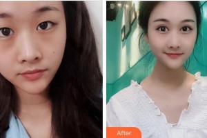 成都愛迪眼科醫(yī)院康黔整形價格表附雙眼皮案例展示