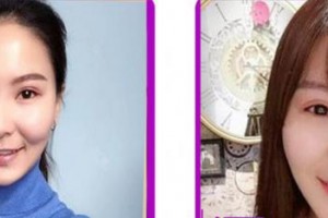 成都愛迪眼科醫(yī)院晏大倫整形價格表附雙眼皮案例展示