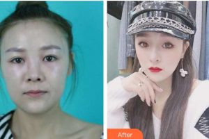 廣州軍區(qū)武漢總醫(yī)院醫(yī)學(xué)整形美容中心孫艷春整形價(jià)格表附面包臉到鴨蛋臉變形記案例展示