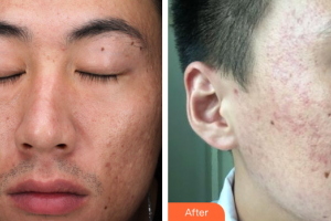 廣州軍區(qū)武漢總醫(yī)院醫(yī)學(xué)整形美容中心黃巧玲整形價(jià)格表附痘坑綜合調(diào)節(jié)案例展示