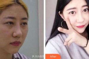 成都愛迪眼科醫(yī)院張軍軍整形價格表附全切雙眼皮案例展示