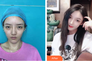 廣州晨曦醫(yī)療美容醫(yī)院宋寅洙整形價(jià)格表附假體眉弓案例展示