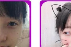 成都愛迪眼科醫(yī)院周波整形價格表附眼部綜合案例展示