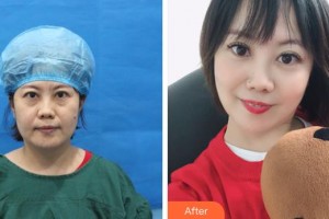 成都愛迪眼科醫(yī)院霍紅利整形價格表附不開刀祛眼袋+自體脂肪填充淚案例展示