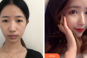 成都市新都區(qū)人民醫(yī)院眼科李翠整形價格表附眼部綜合案例展示