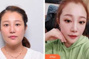 成都佰視達眼科門診部趙小虎整形價格表附眼部綜合案例展示