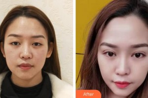 成都普瑞眼科醫(yī)院周繼容整形價格表附提眉術(shù)案例展示