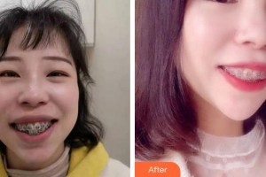 成都亞非牙科醫(yī)院李洲整形價格表附牙齒矯正案例展示
