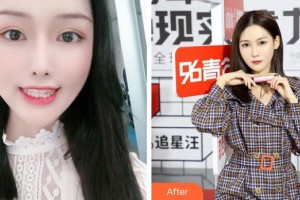 成都華西牙種植醫(yī)院楊小東整形價格表附牙綜合案例展示