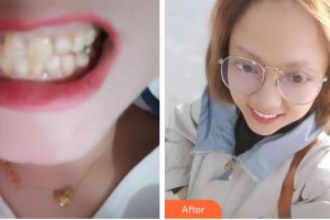 成都市新都區(qū)人民醫(yī)院眼科陳建軍整形價格表附牙綜合案例展示