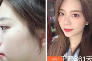 成都君臣口腔門診部董彰實整形價格表附金屬托槽矯正案例展示