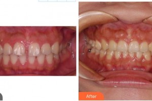 成都華西牙種植醫(yī)院劉果生整形價格表附牙齒正畸案例展示