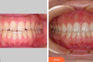 成都君臣口腔門診部霖整形價(jià)格表附牙齒正畸案例展示