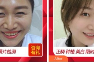 成都德道口腔醫(yī)院羅君整形價(jià)格表附美白牙齒案例展示