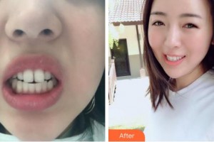 成都潔西口腔診所王周斌整形價(jià)格表附隱形矯正案例展示