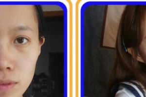 成都愛視眼科醫(yī)院李新立整形價(jià)格表附眼部手術(shù)案例展示