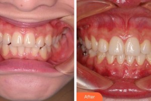 成都純?？谇辉\所劉明曦整形價(jià)格表附牙齒正畸案例展示