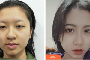 成都天姿醫(yī)療美容門診部譚超整形價(jià)格表附切開雙眼皮案例展示