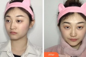 成都中醫(yī)大銀海眼科醫(yī)院鄧亞平整形價(jià)格表附眼部整形案例展示