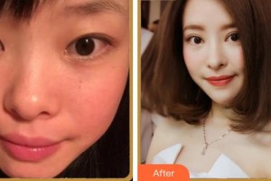 成都中醫(yī)大銀海眼科醫(yī)院段俊國(guó)整形價(jià)格表附眼部多項(xiàng)案例展示