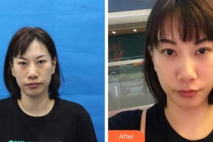 成都中醫(yī)大銀海眼科醫(yī)院張富文整形價(jià)格表附去眼袋案例展示