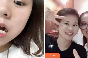 成都春天牙科門診部彭英整形價(jià)格表附牙齒矯正案例展示