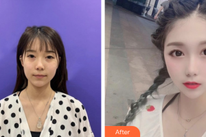 廣州康華清醫(yī)學(xué)美容門診部萬佩整形價(jià)格表附光子嫩膚案例展示