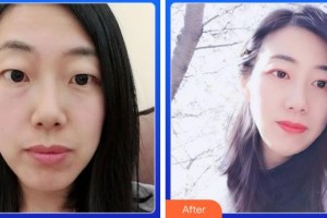 成都中醫(yī)大銀海眼科醫(yī)院廖品正整形價格表附雙眼皮案例展示