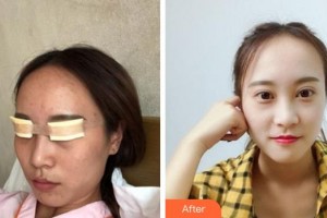 成都中醫(yī)大銀海眼科醫(yī)院謝艾芮整形價格表附眼部手術案例展示