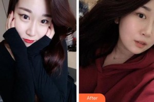 成都中醫(yī)大銀海眼科醫(yī)院繆馨整形價格表附眼部綜合案例展示