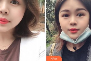 成都中醫(yī)大銀海眼科醫(yī)院陳浩整形價格表附雙眼皮案例展示