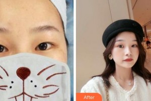 成都中醫(yī)大銀海眼科醫(yī)院蒙軒住院醫(yī)師整形價格表附眼部手術案例展示