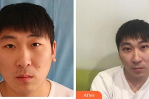 成都中醫(yī)大銀海眼科醫(yī)院王利萍住院醫(yī)師整形價格表附切開雙眼皮案例展示