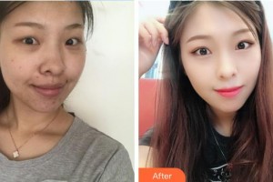 成都新視界眼科醫(yī)院賈春月整形價格表附眼部手術案例展示