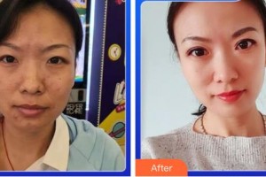 成都新視界眼科醫(yī)院余小清整形價格表附5s重瞼術+超微創(chuàng)開內(nèi)眥案例展示