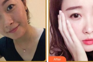 成都新視界眼科醫(yī)院趙江華整形價格表附眼部多項案例展示