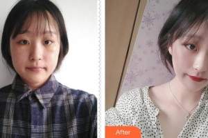 成都新視界眼科醫(yī)院唐建整形價格表附眼部整形案例展示