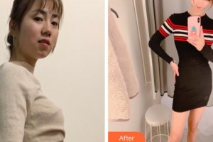 福建武警總隊(duì)醫(yī)院激光美容中心林美回整形價(jià)格表附光子套餐案例展示