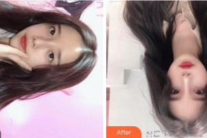 福建武警總隊(duì)醫(yī)院激光美容中心張召整形價(jià)格表附微針美膚案例展示