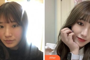 福建武警總隊(duì)醫(yī)院激光美容中心余文杰整形價(jià)格表附美白嫩膚案例展示