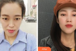 福建醫(yī)科大學(xué)附屬第二醫(yī)院眼科中心陳淑端整形價(jià)格表附切開雙眼皮案例展示