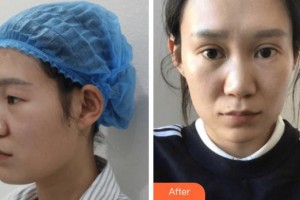 福建醫(yī)科大學(xué)附屬第二醫(yī)院眼科中心葉克菁整形價(jià)格表附雙眼皮案例展示