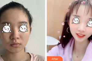 廣州從化現(xiàn)代醫(yī)院廖安整形價(jià)格表附光子嫩膚案例展示